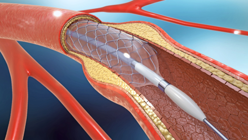 FDA Approves a High-Performance Stent – First of its Kind in Nearly Two Decades