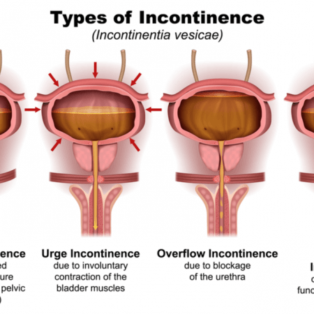 How Urinary Incontinence Affects Female Athletic Performance