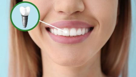 Why All on Four Is the Best of Both Worlds when It Comes to Dental Implants
