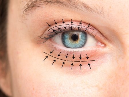 5 Tips for a Speedy Recovery After Double Eyelid Surgery (Blepharoplasty)