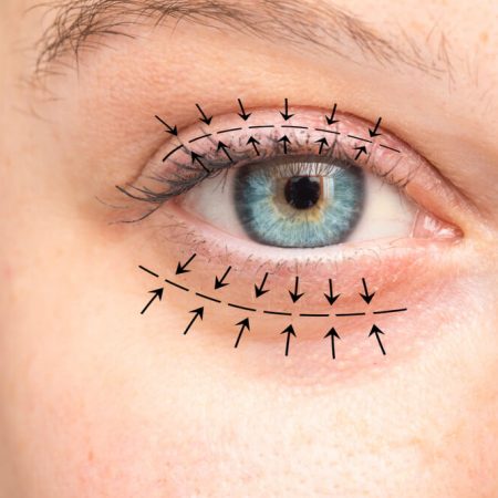 5 Tips for a Speedy Recovery After Double Eyelid Surgery (Blepharoplasty)
